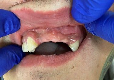 A man is getting his teeth examined by a dentist.