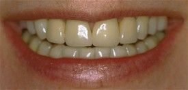 A close up of a person 's smile with white teeth.