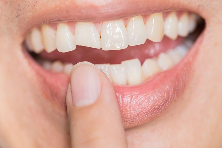 Woman pointing at her chipped tooth
