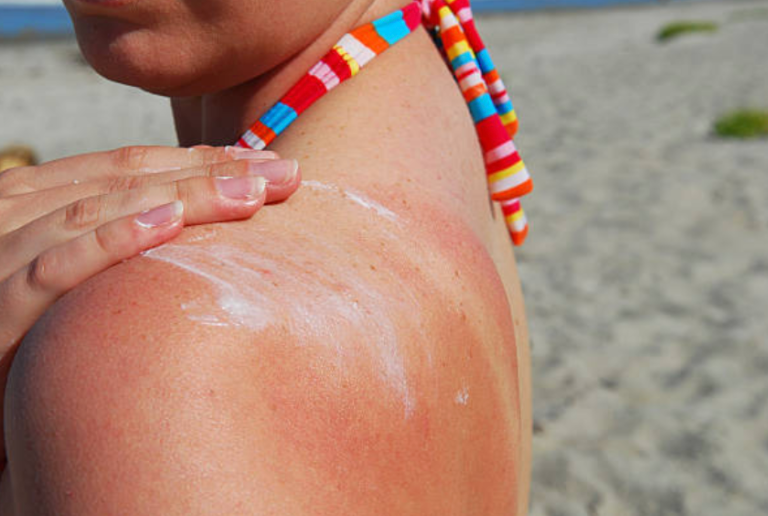 A woman is applying sunscreen to her shoulder on the beach.