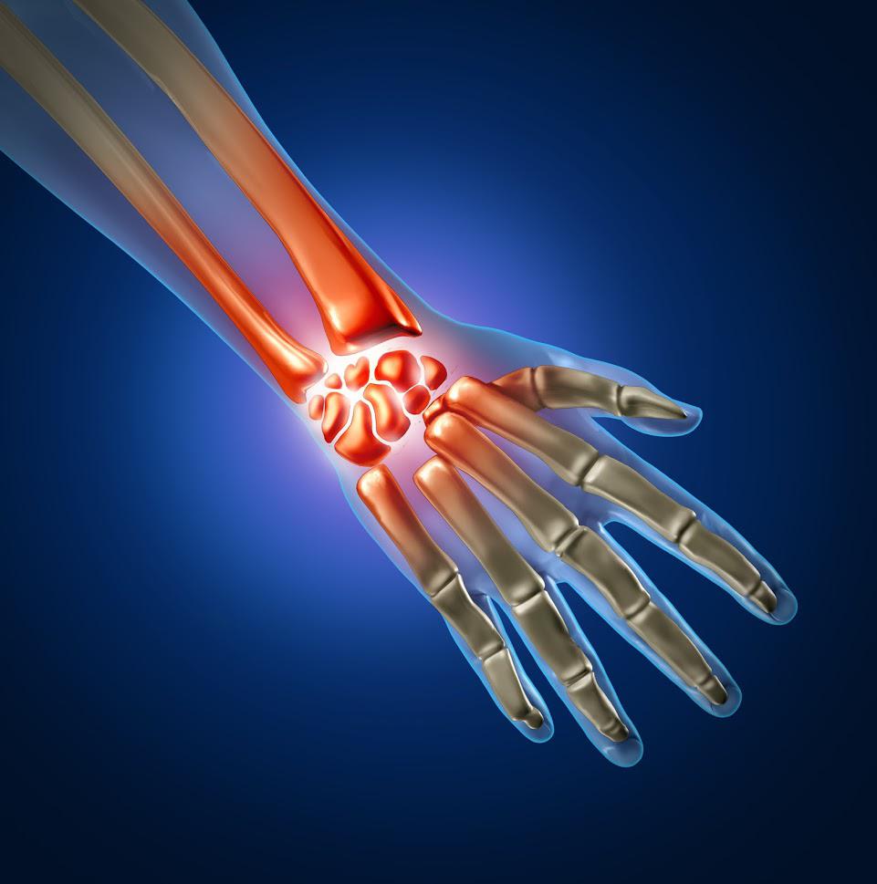 Carpal Tunnel Syndrome: Frequently Asked Questions