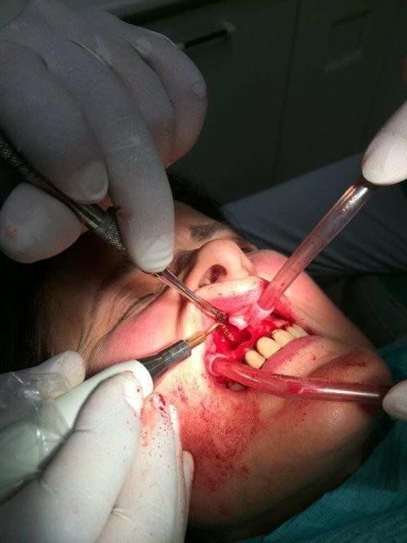 Operazione chirurgica alla mascella