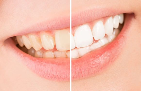sbiancamento dentale prima e dopo