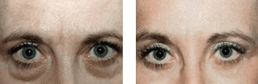 Effetti di intervento di chirurgia estetica delle palpebre