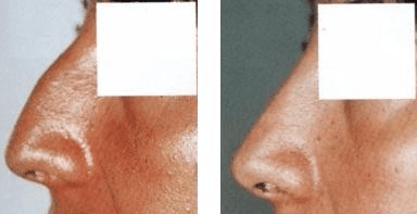 Effetti di intervento di rinoplastica