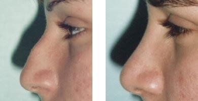 Effetti di un intervento di rinoplastica su una donna