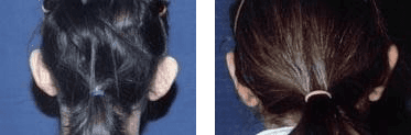 Nuca di donna prima e dopo un intervento di ortoplastica