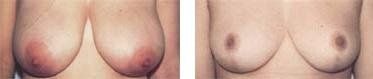 Effetti di un intervento di mastoplastica riduttiva