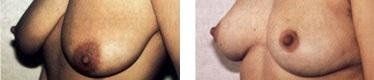 Seno femminile prima e dopo intervento di mastoplastica riduttiva