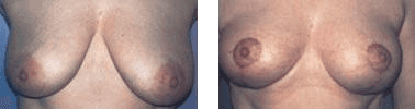 Effetti di un intervento di mastopessi su mammelle femminili