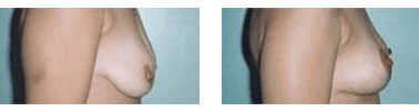 Seno femminile prima e dopo un intervento di mastopessi
