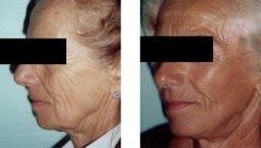 Effetti del lifting facciale su donna anziana