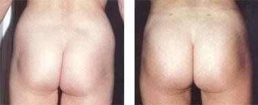 Fianchi e glutei femminili dopo intervento di lipoaspirazione