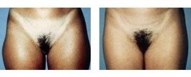 Effetti di lipoaspirazione su cosce femminili