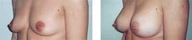 Effetti della mastoplastica additiva