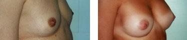 Seno femminile prima e dopo un intervento di mastoplastica additiva