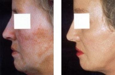 Volto femminile prima e dopo trattamento di peeling chimico