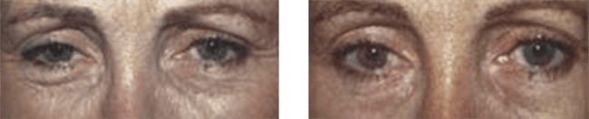 Occhi femminili prima e dopo trattamenti estetici con effetto 