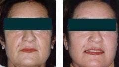 Effetti del lifting facciale su donna di mezza età