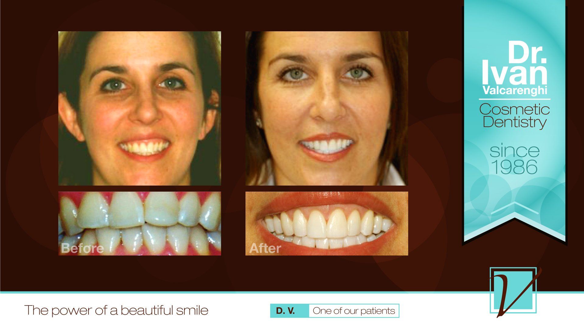 Woman with Clean Teeth — Elmhurst, IL — Radiante Dental