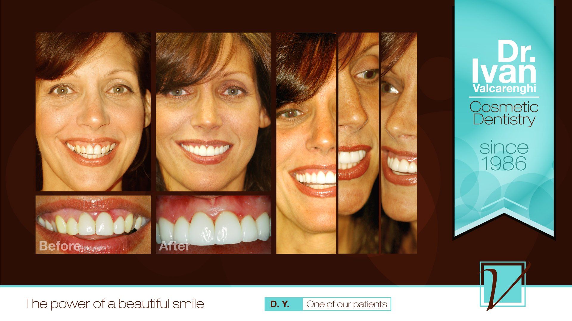 Woman with Align Teeth — Elmhurst, IL — Radiante Dental