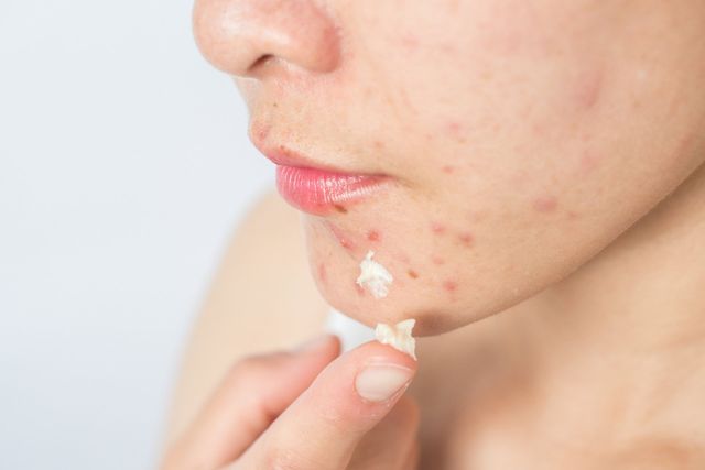 Dark Spots vs. Acne Scars: How to Spot the Differences & Treat
