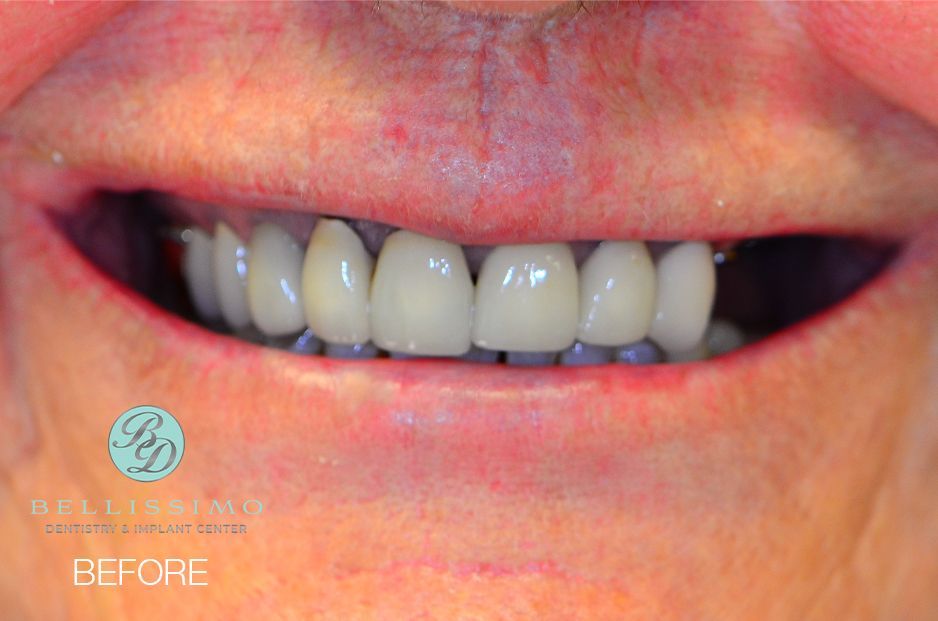 A close up of a person 's teeth before dental work