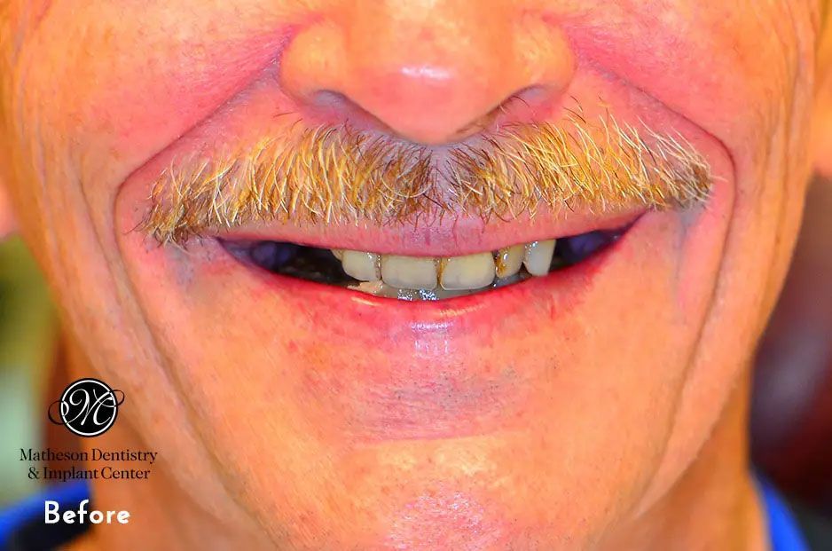 A man with a mustache and missing teeth is smiling.