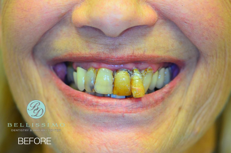 A close up of a woman 's teeth before dental work.