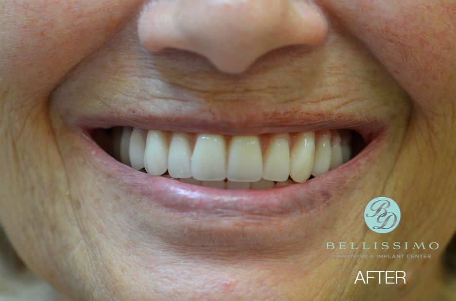 A close up of a woman 's smile with white teeth.