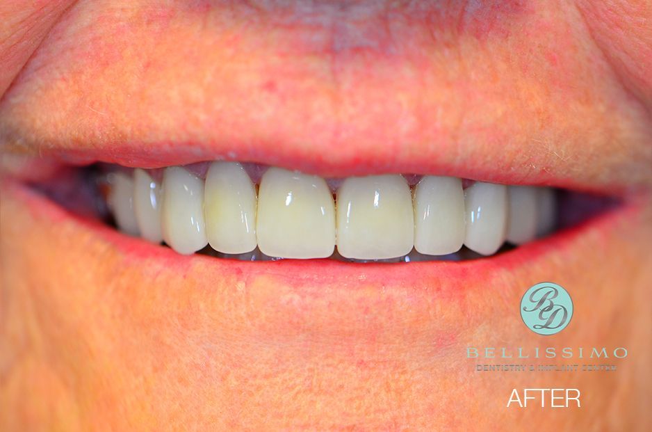 A close up of a woman 's teeth after dental treatment.