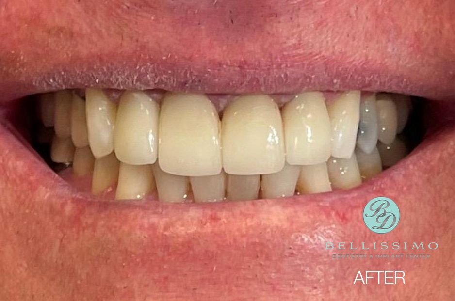 A close up of a person 's teeth after dental treatment.