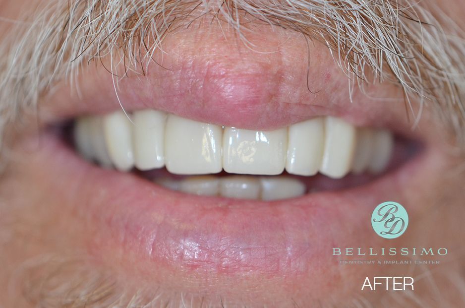 A close up of a man 's mouth with white teeth.