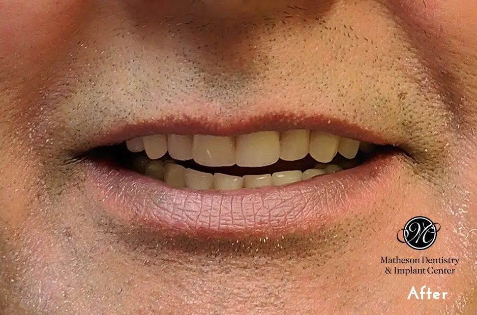 A close up of a man 's mouth with white teeth