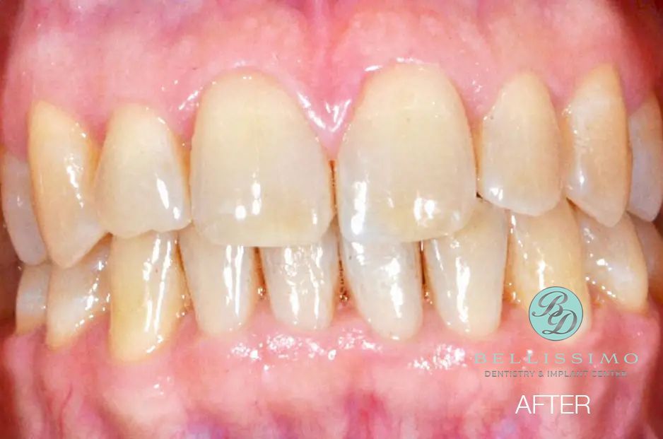 A close up of a person 's teeth after a dental treatment.