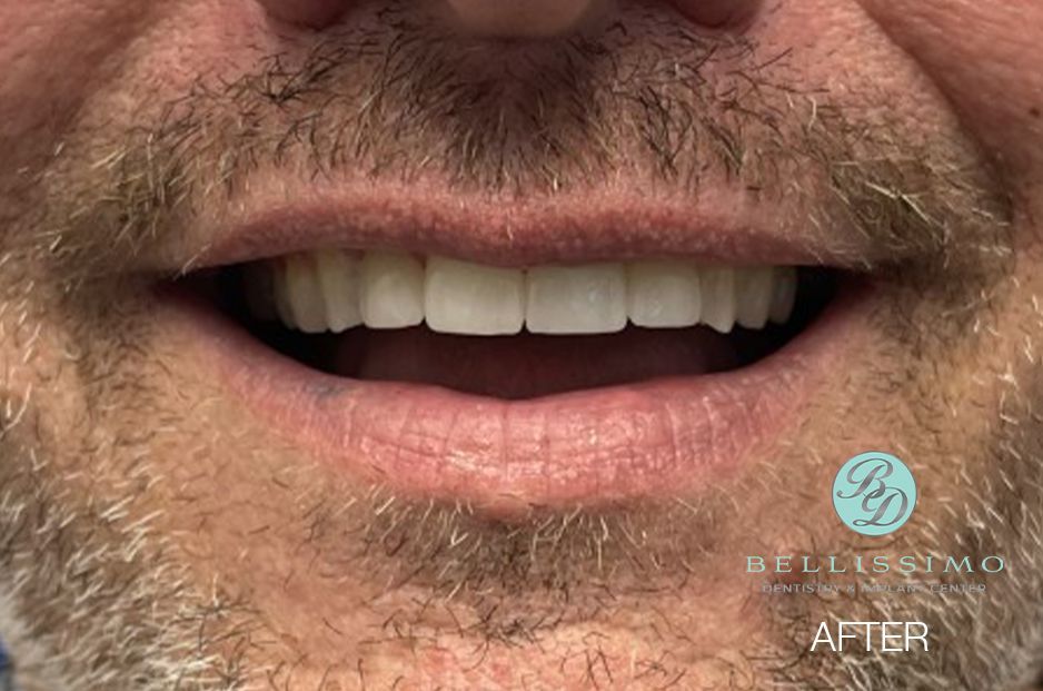 A close up of a man 's mouth with a beard and white teeth.