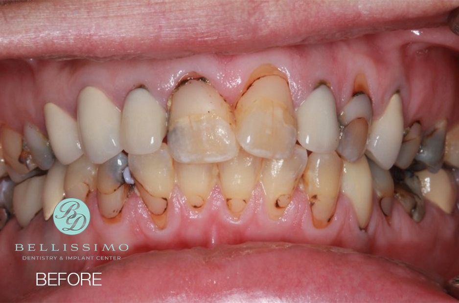 A close up of a person 's teeth before dental work