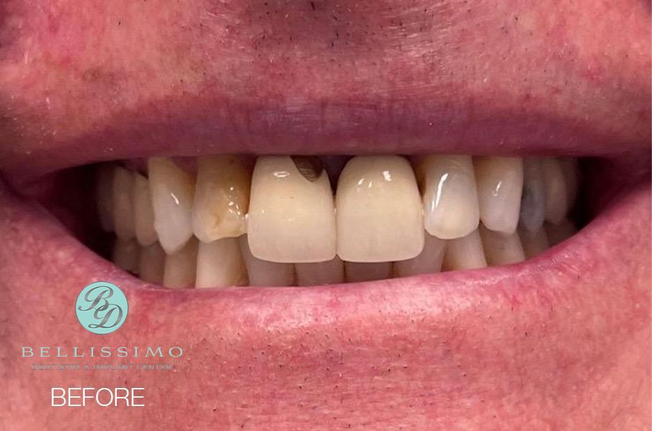 A close up of a person 's teeth before dental treatment.