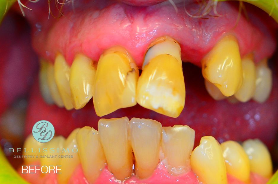 A close up of a person 's teeth before dental work