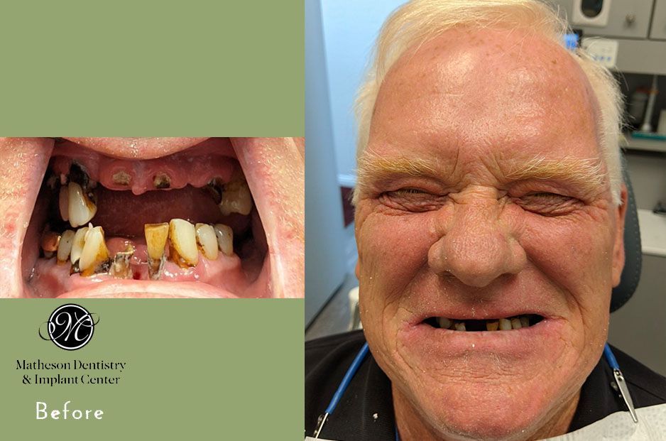 A picture of a man 's teeth before and after treatment