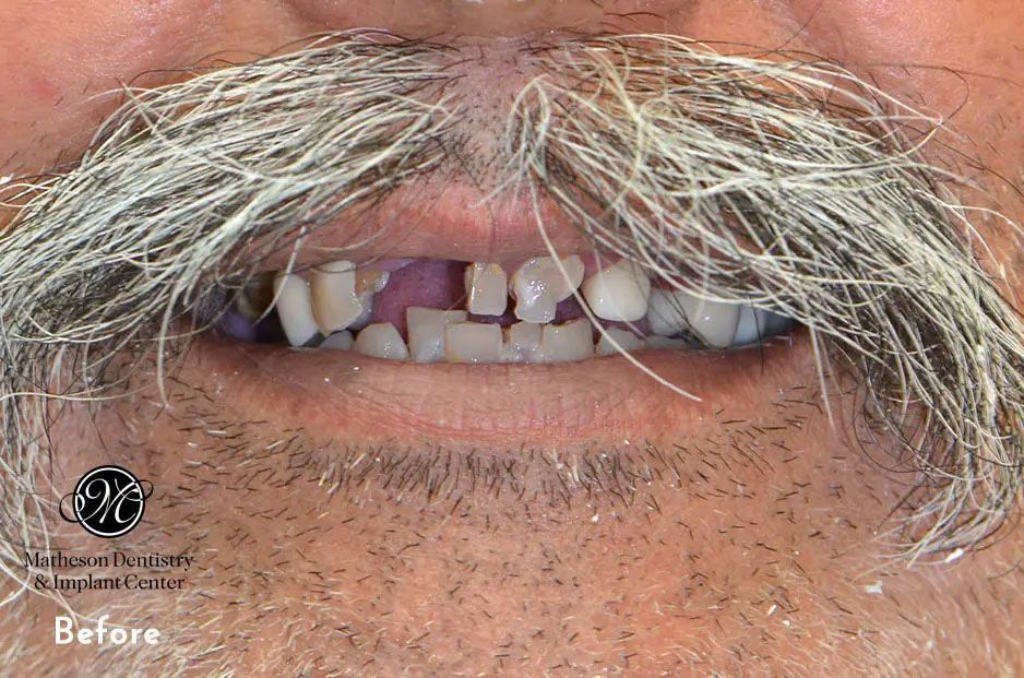 A man with a beard and mustache has missing teeth.