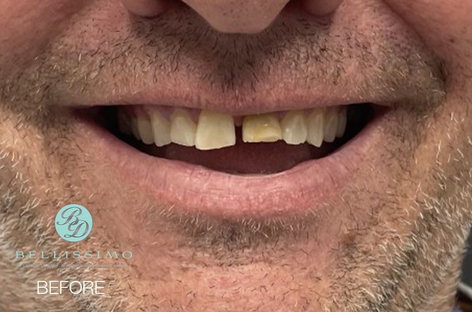 A close up of a man 's mouth with missing teeth.