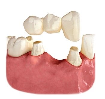 A model of a dental bridge on a white background.