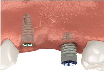 A computer generated image of a tooth with two dental implants in it.