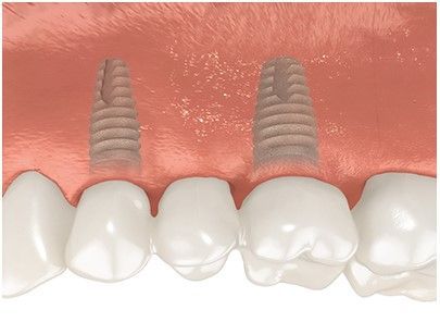 A computer generated image of a person 's teeth with two dental implants.