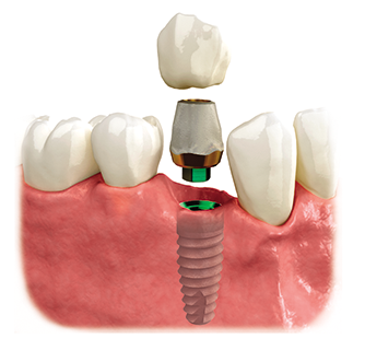 An illustration of a dental implant with a crown on top