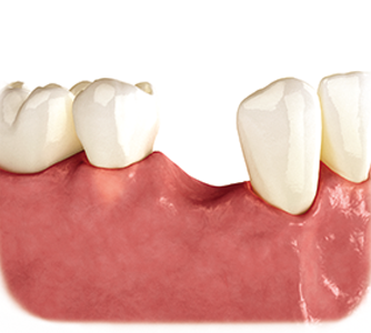 A model of a tooth with a missing tooth.