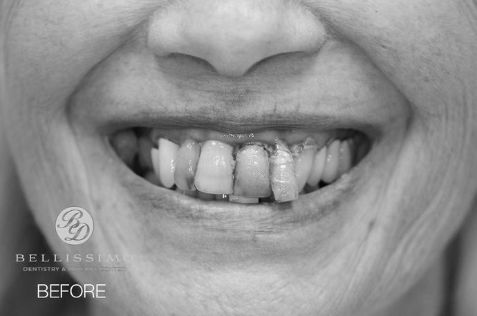 A woman 's teeth are shown in a black and white photo.