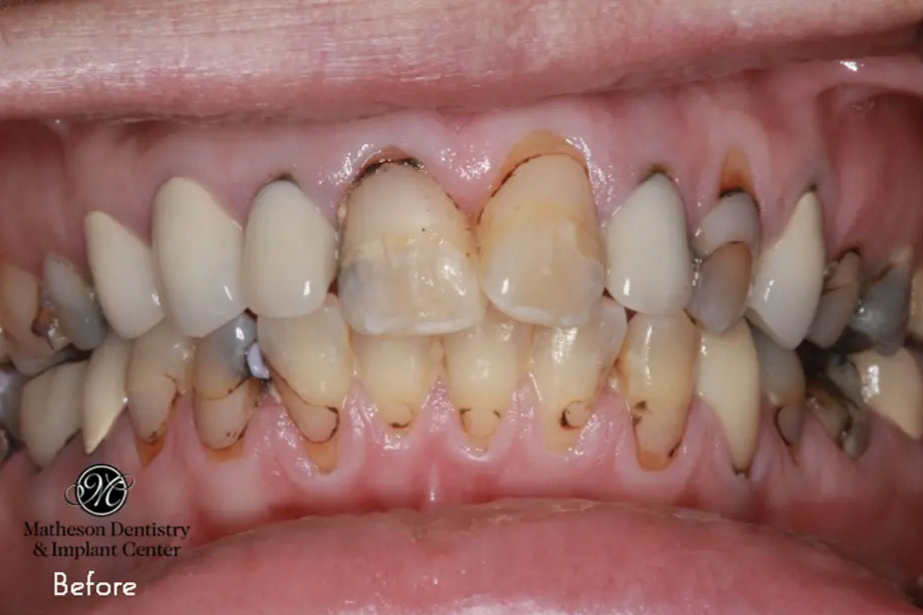 A close up of a person 's teeth before dental work