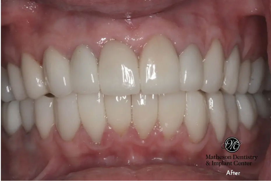 A close up of a person 's teeth with white teeth